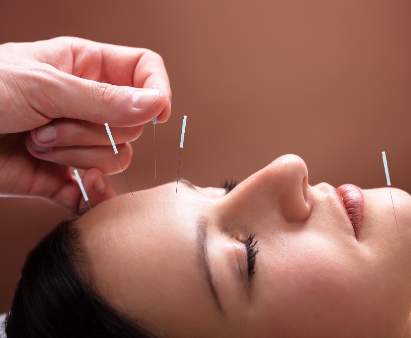 Cosmetic acupuncture facial rejuvenation at The Durand Clinic