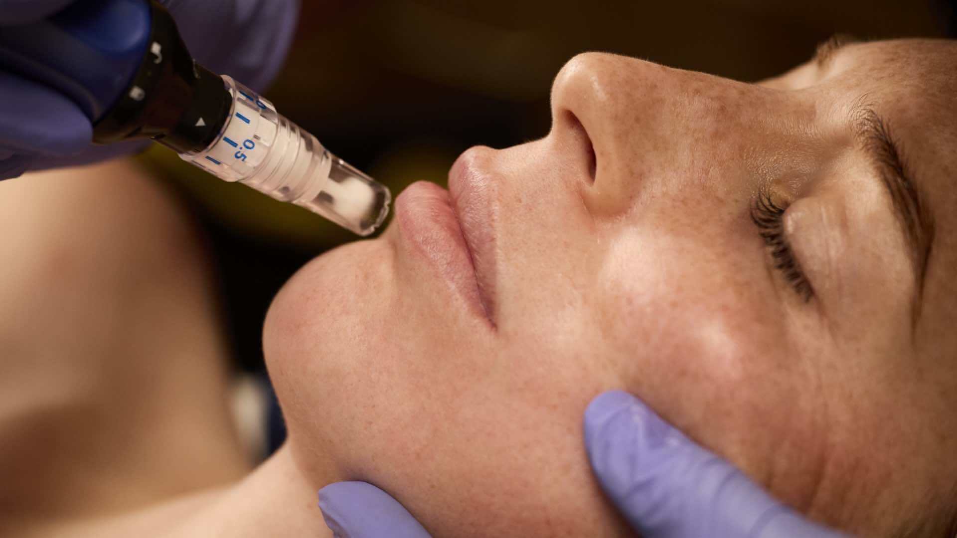 Microneedling treatment at The Durand Clinic
