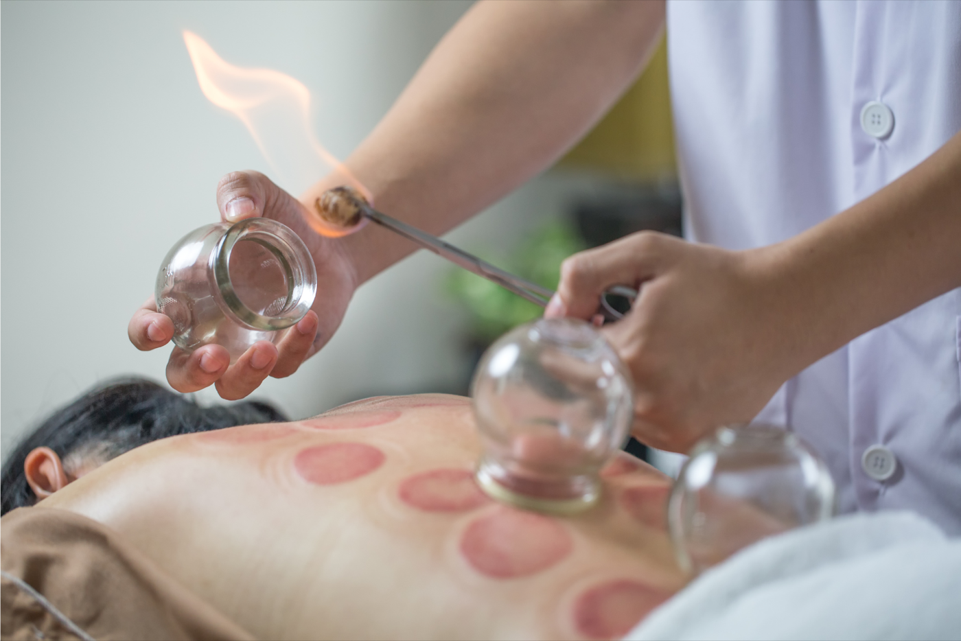 The Durand Clinic — Cupping therapy treatment