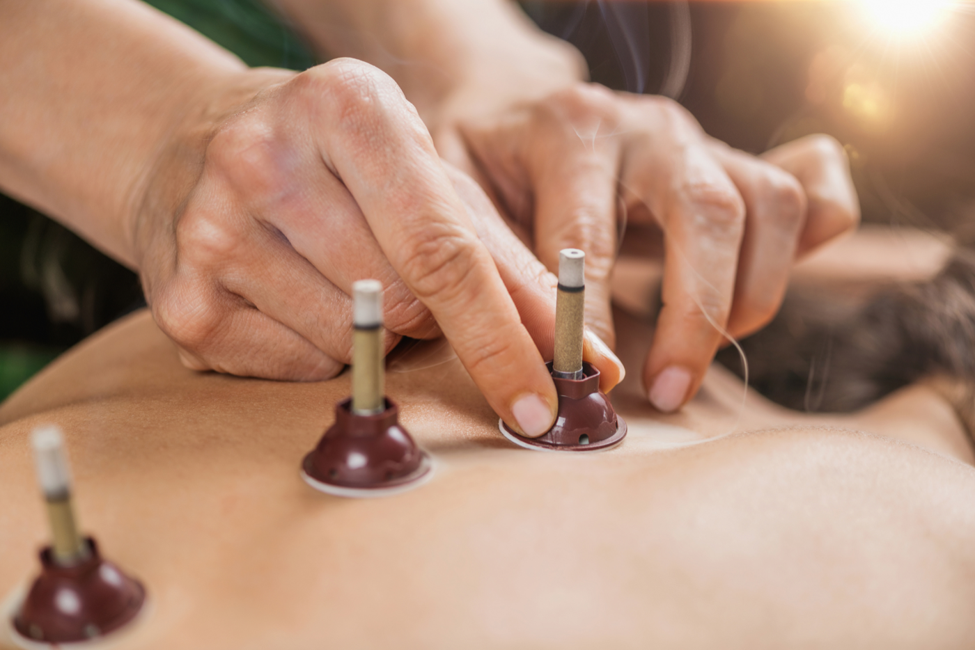 The Durand Clinic — Moxibustion treatment